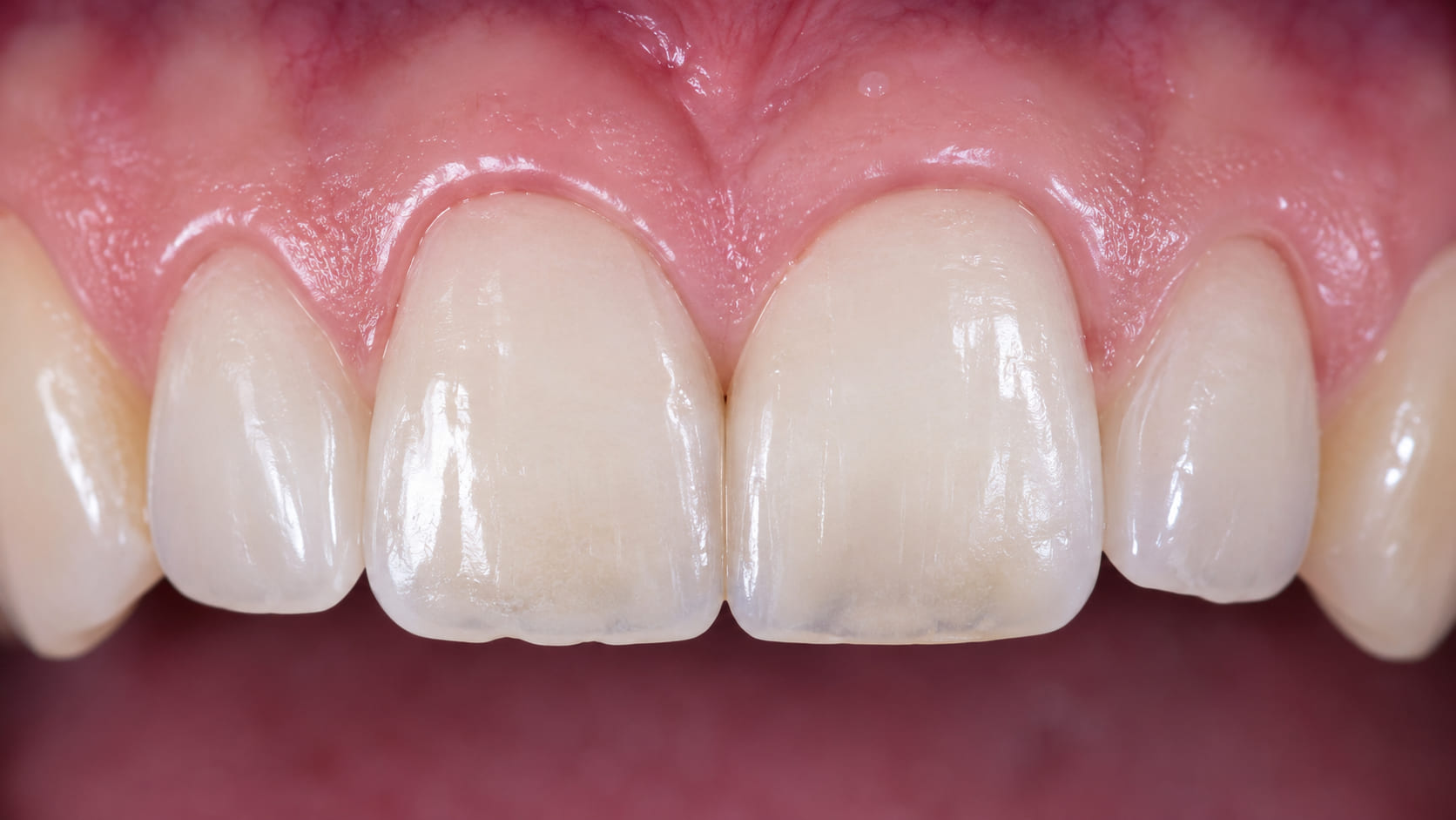 Il dettaglio di un dente ricostruito in modo mini-invasivo.